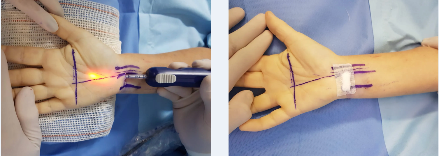 Via endoscopica