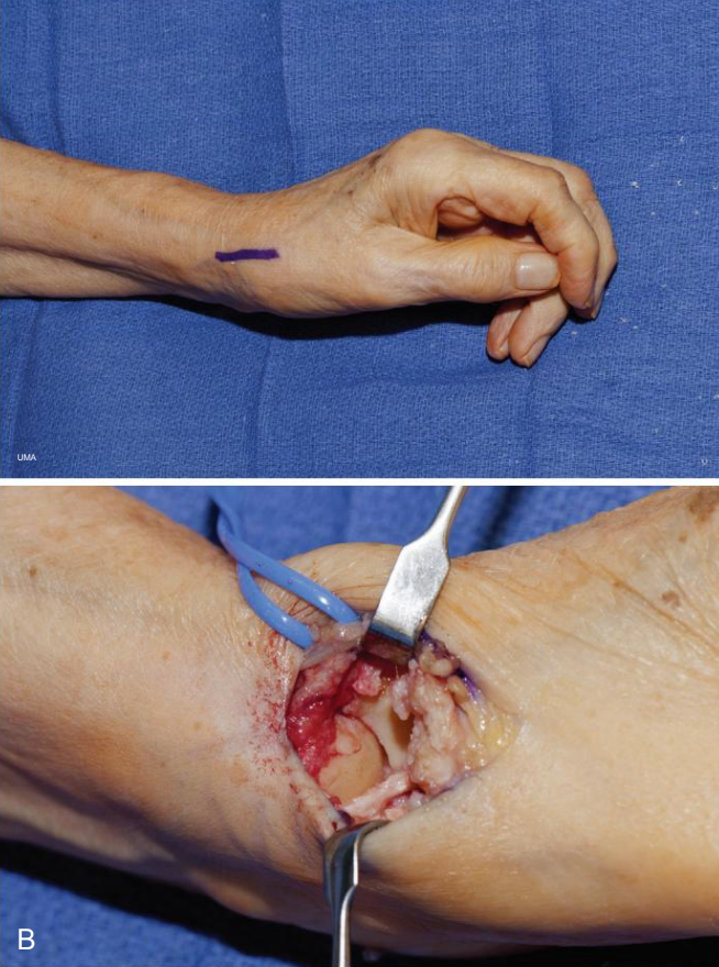 Trapezectomia