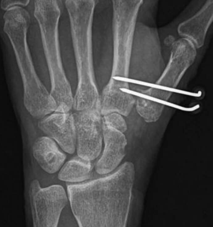 Trapezectomia