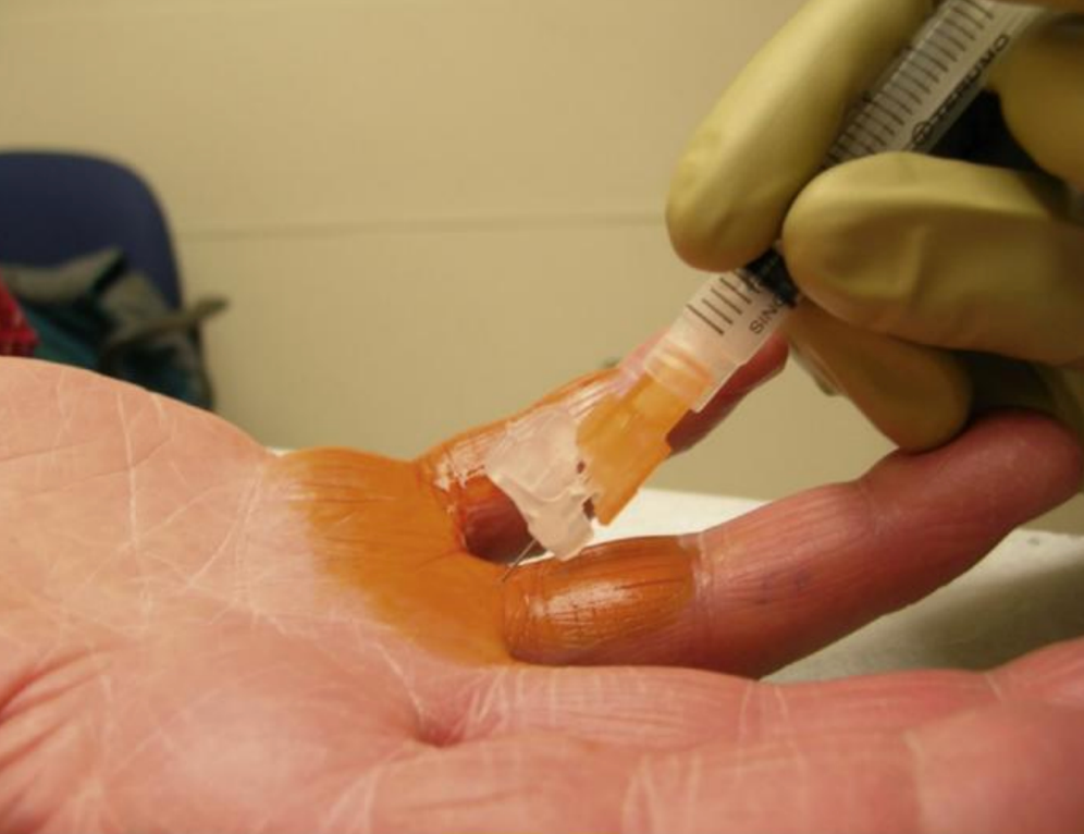 INFILTRAÇÃO COM CORTICOIDE