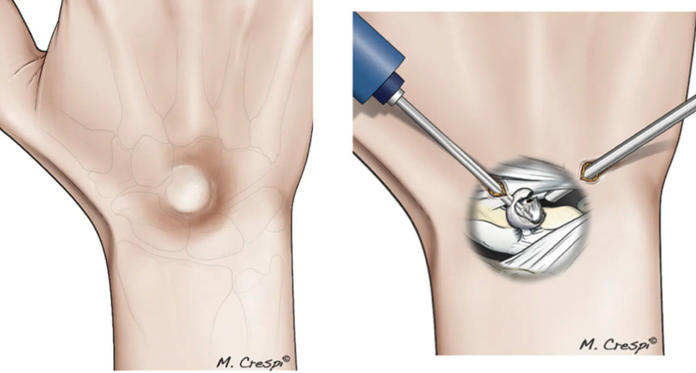 CIRURGIA POR ARTROSCOPIA