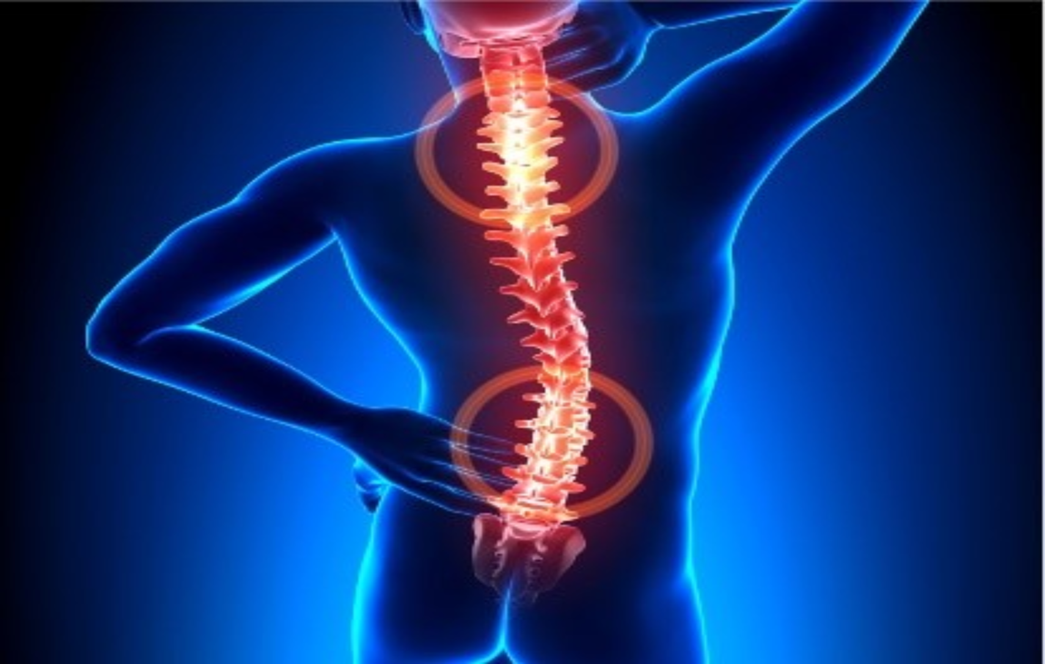 senile scoliosis