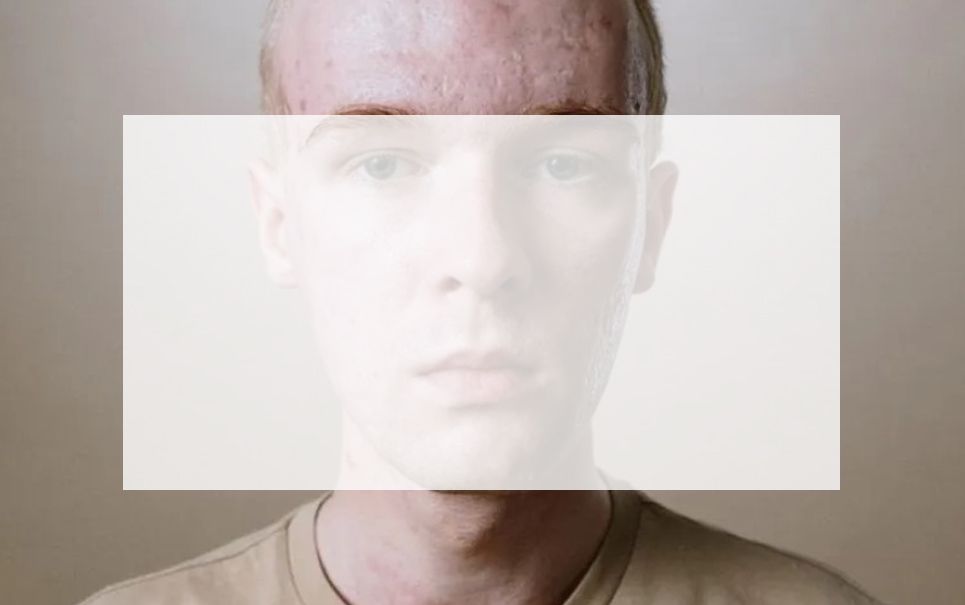 Acne Scar treatments in Leeds