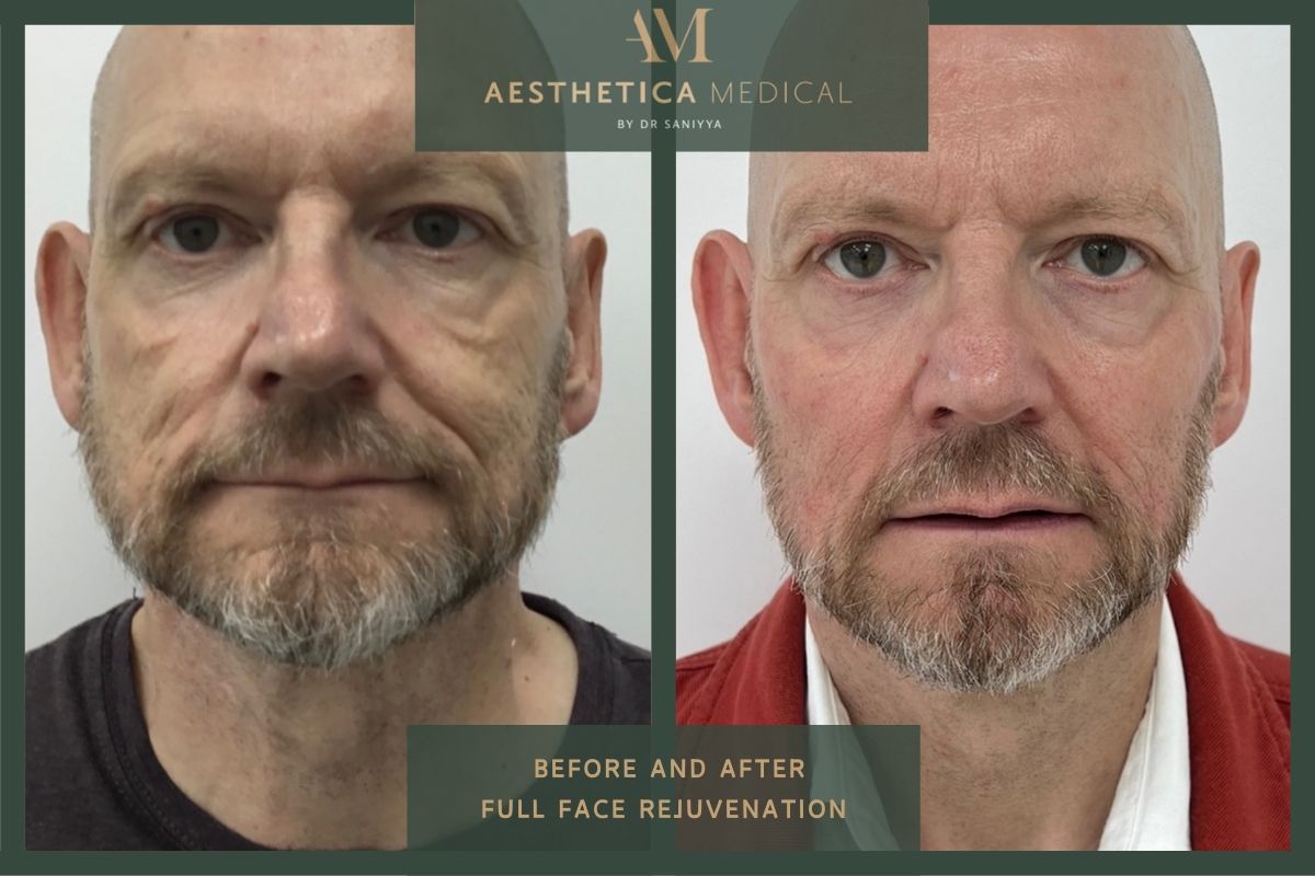 Full face rejuvenation before and after