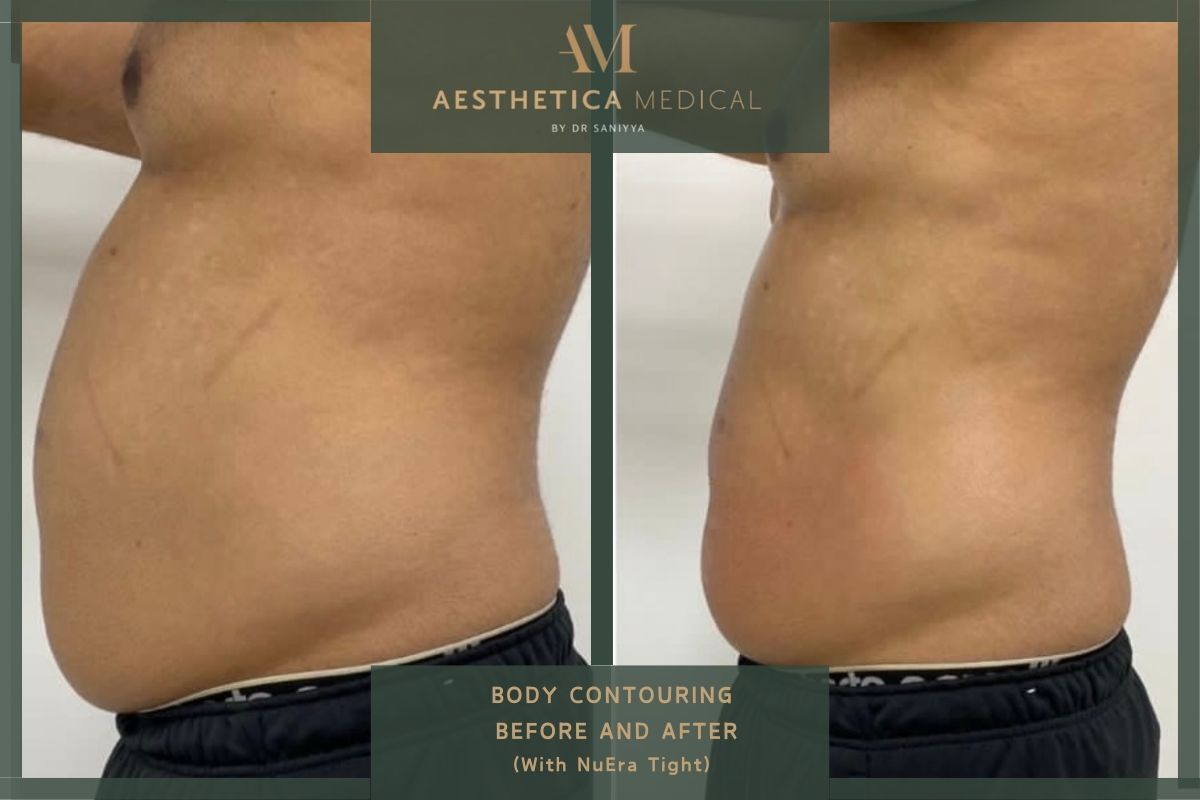 Body sculpting before and after