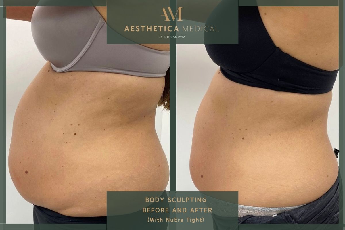Body sculpting before and after