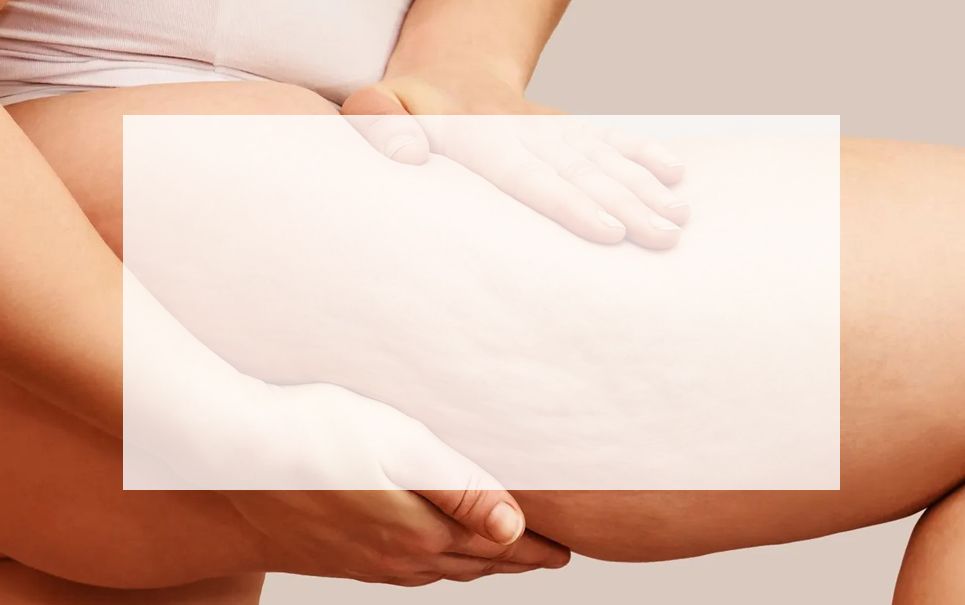 Cellulite treatments at our Cheshire Clinic