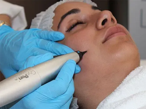 CryoPen Leeds