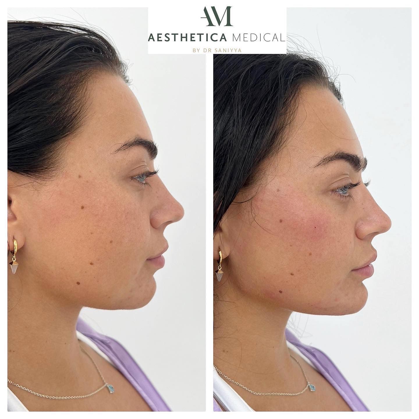 dermal fillers results