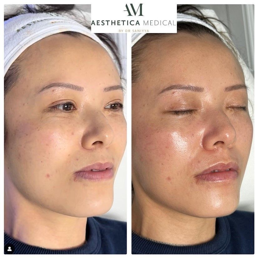 Hydrafacial Treatment Before and After Pics