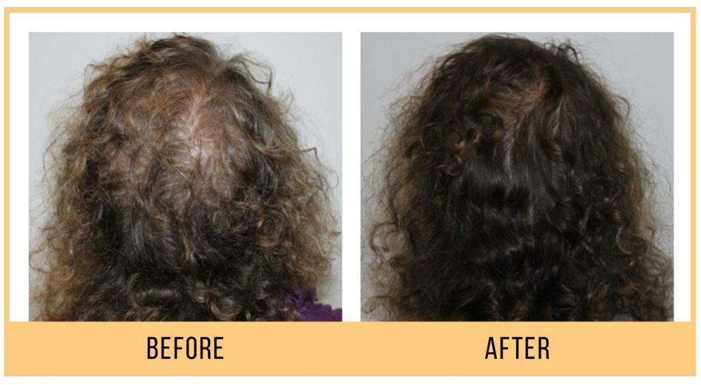 Hydrafacial keravive at Aesthetica Medical