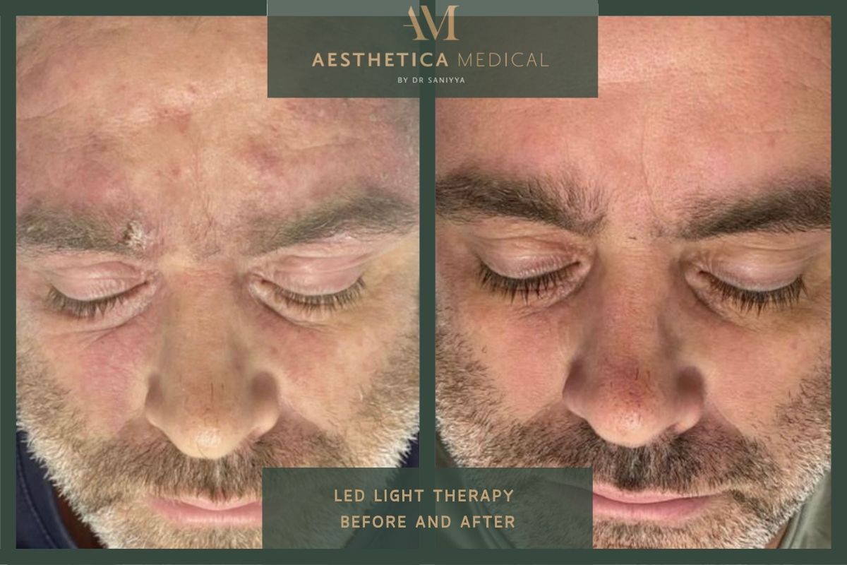Led light therapy before and after
