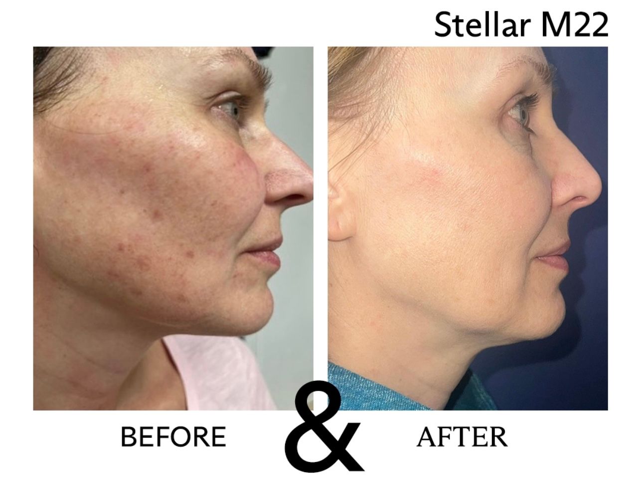Stellar M22 Before and After