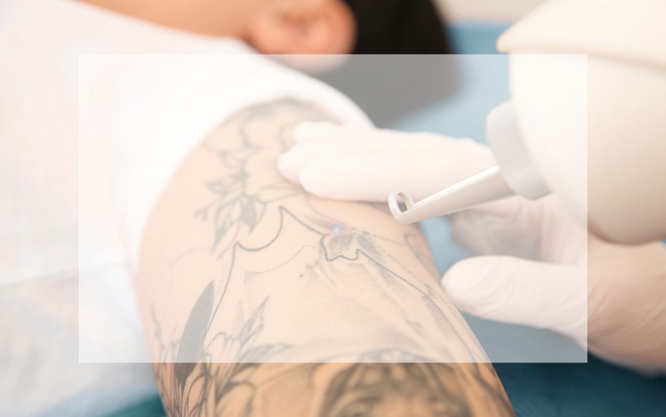 A person is getting a tattoo removed from their arm.