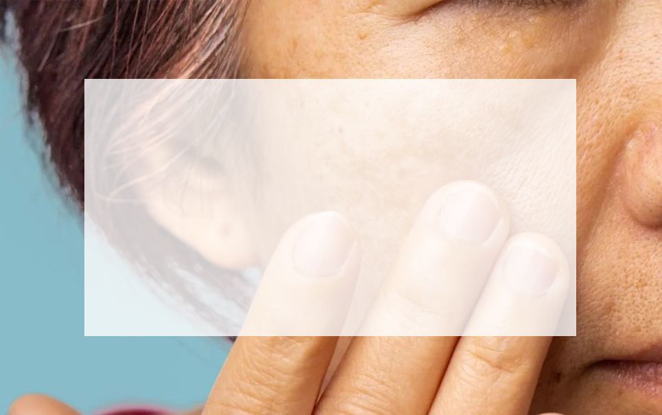 Melasma Patient