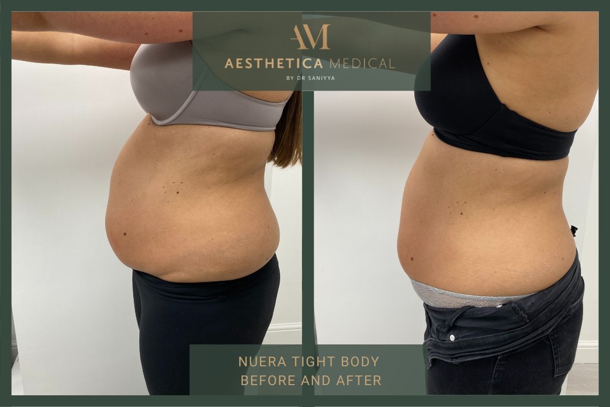 Nuera Tight Body Before And After