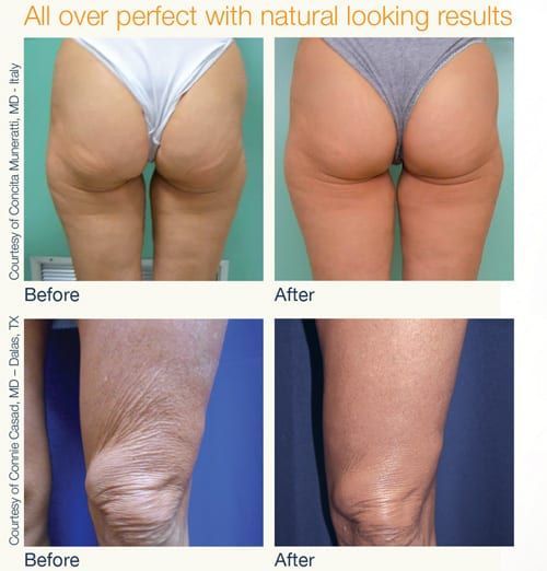 Nuera tight body