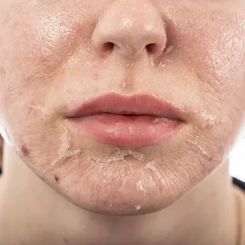 Chemical peels