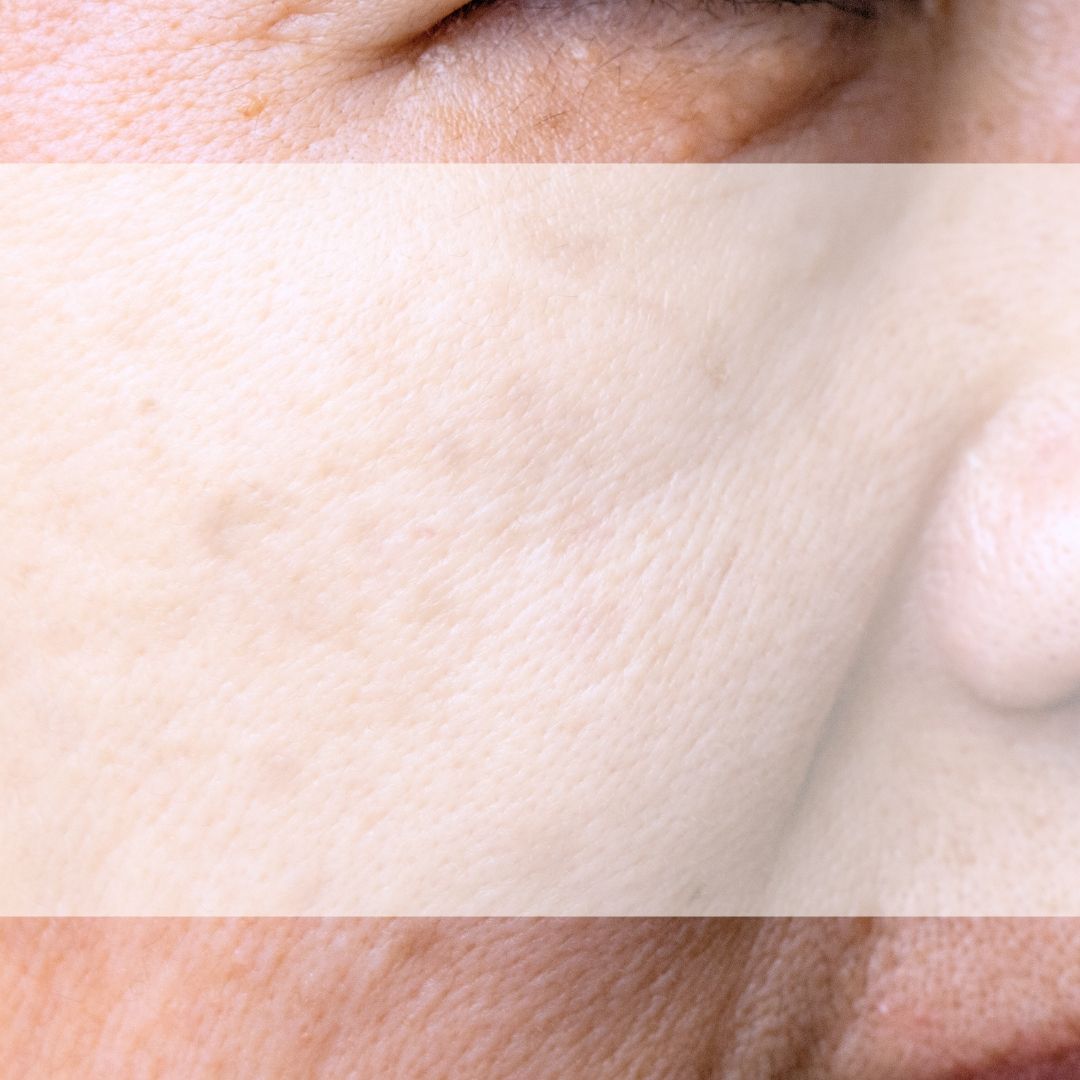 SKIN CONCERN