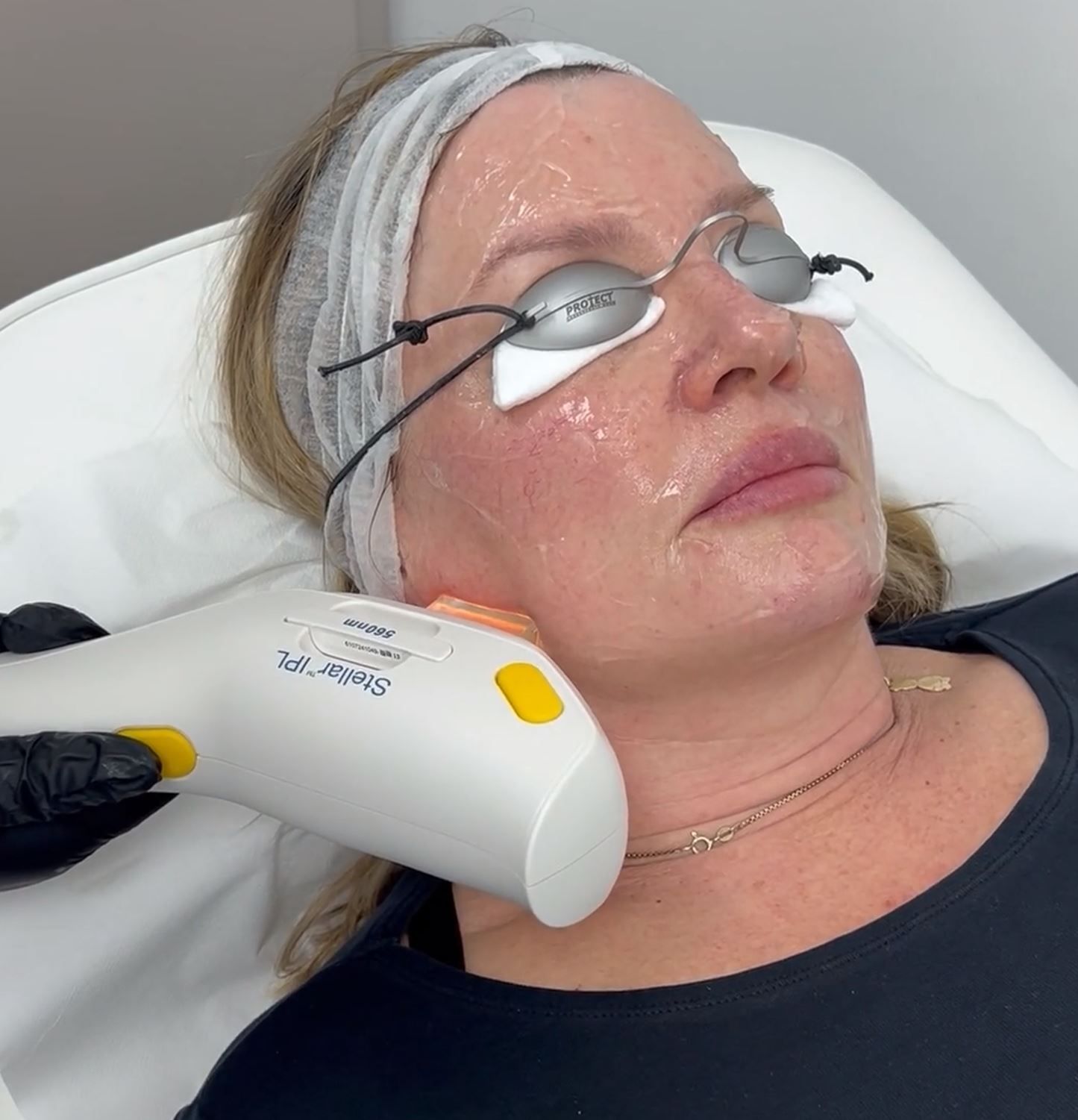 Stellar M22 Treatment