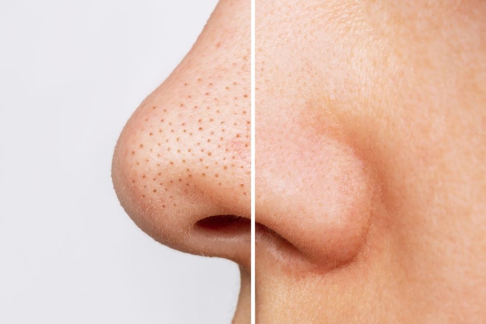 Blackheads hydrafacial