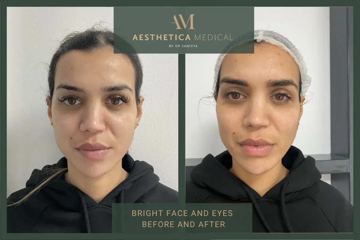 Bright eyes and face before and after pictures