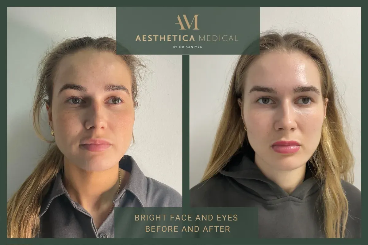 Bright eyes and face treatment before and after