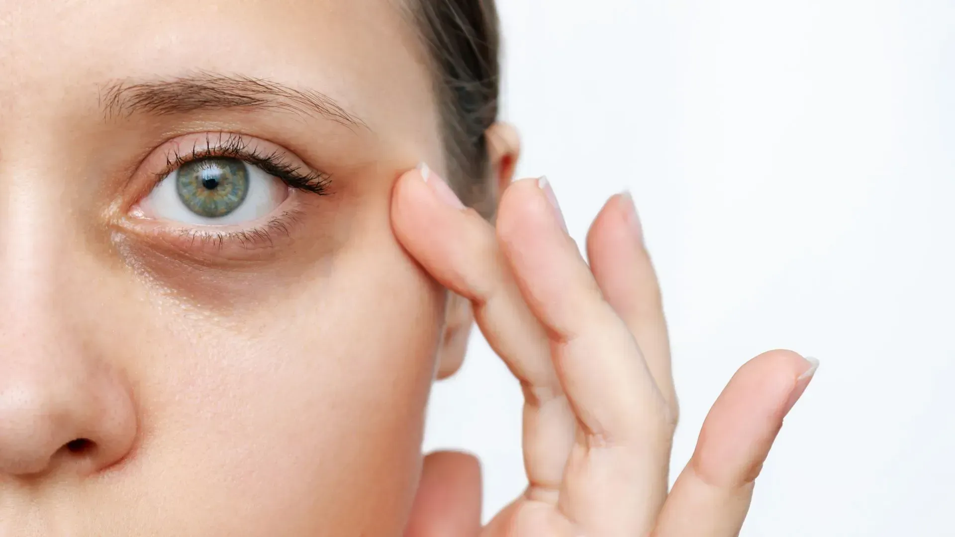 dark circles under eyes