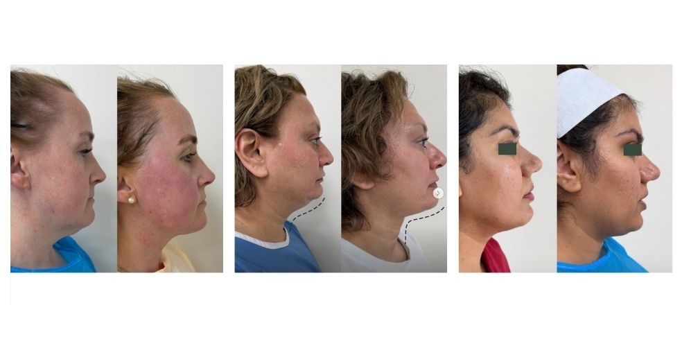 Nuera tight face