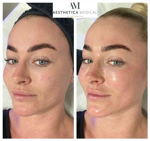 Hydrafacial Before and After