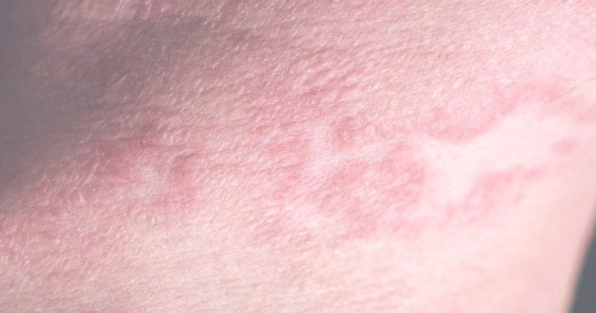 LED therapy for eczema
