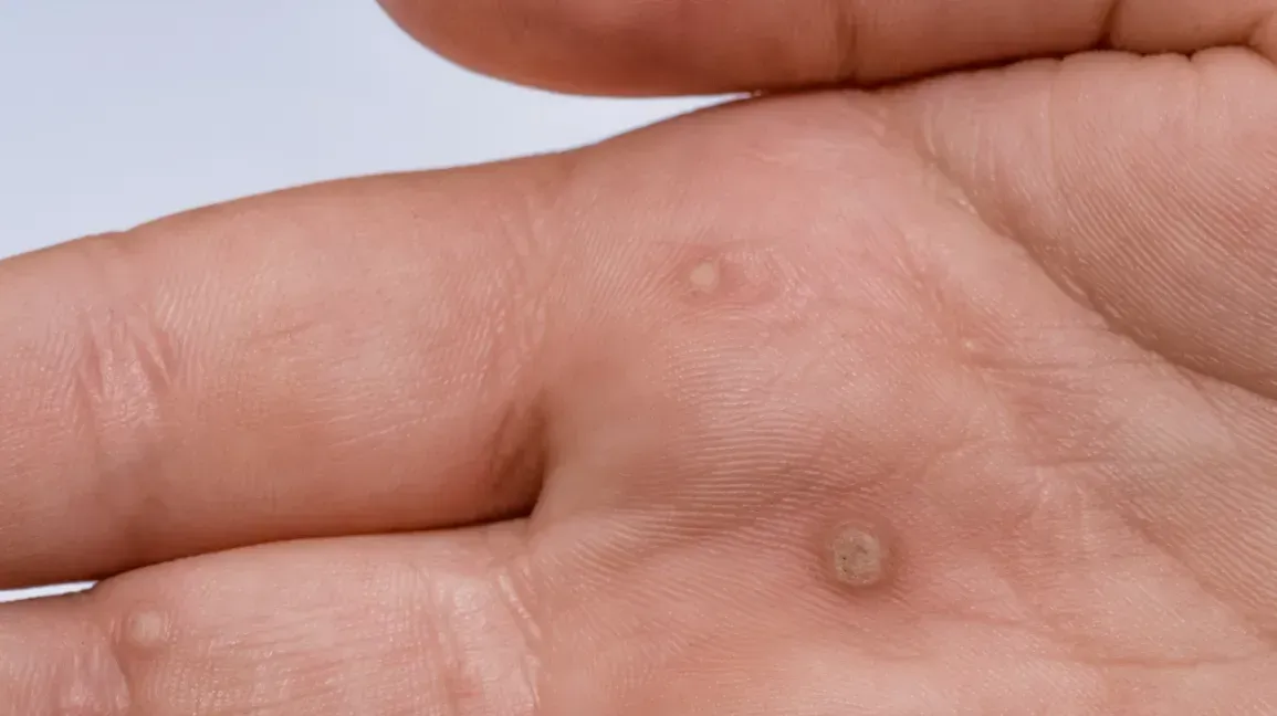 Wart removal in Leeds