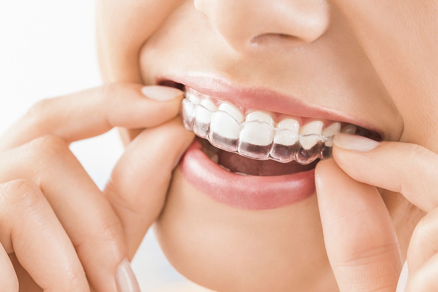 Clear Aligners to Straighten Teeth