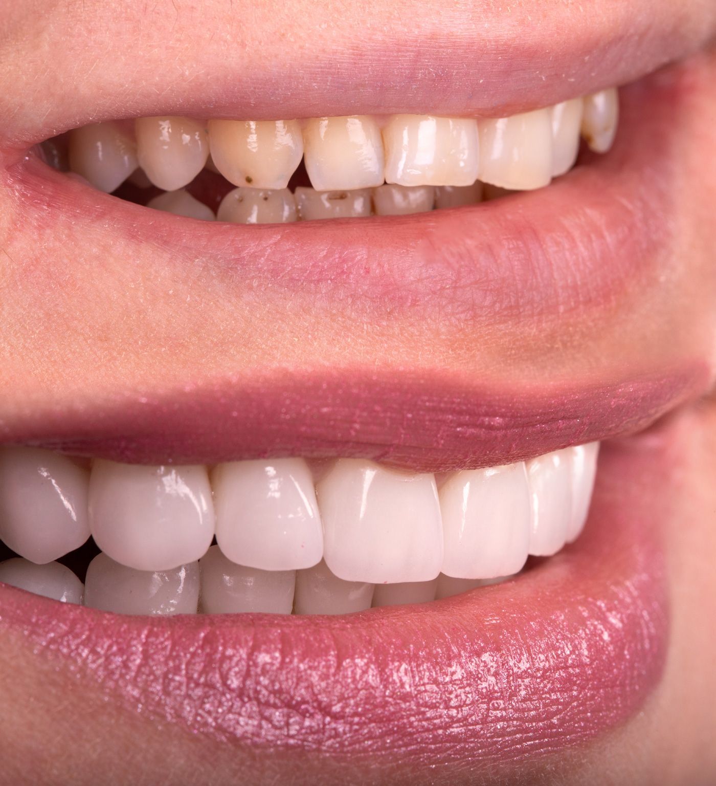 Veneers