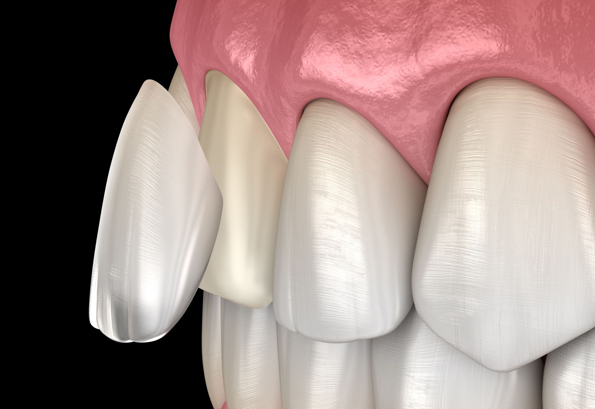 Cosmetic dentistry at Green Pond Dental in Jackson, NJ - enhancing smiles with veneers, teeth whitening, and more.