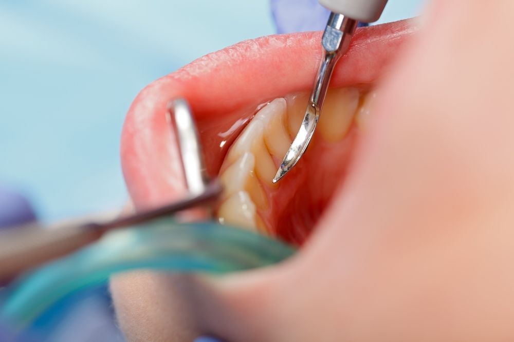 Root canal treatment at Green Pond Dental in Jackson, NJ - alleviating tooth pain and restoring oral health.