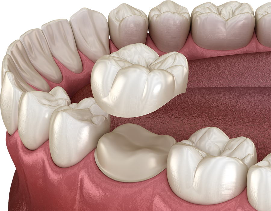 Dental crowns at Green Pond Dental in Jackson, NJ - restoring damaged teeth with durable and protective crowns.