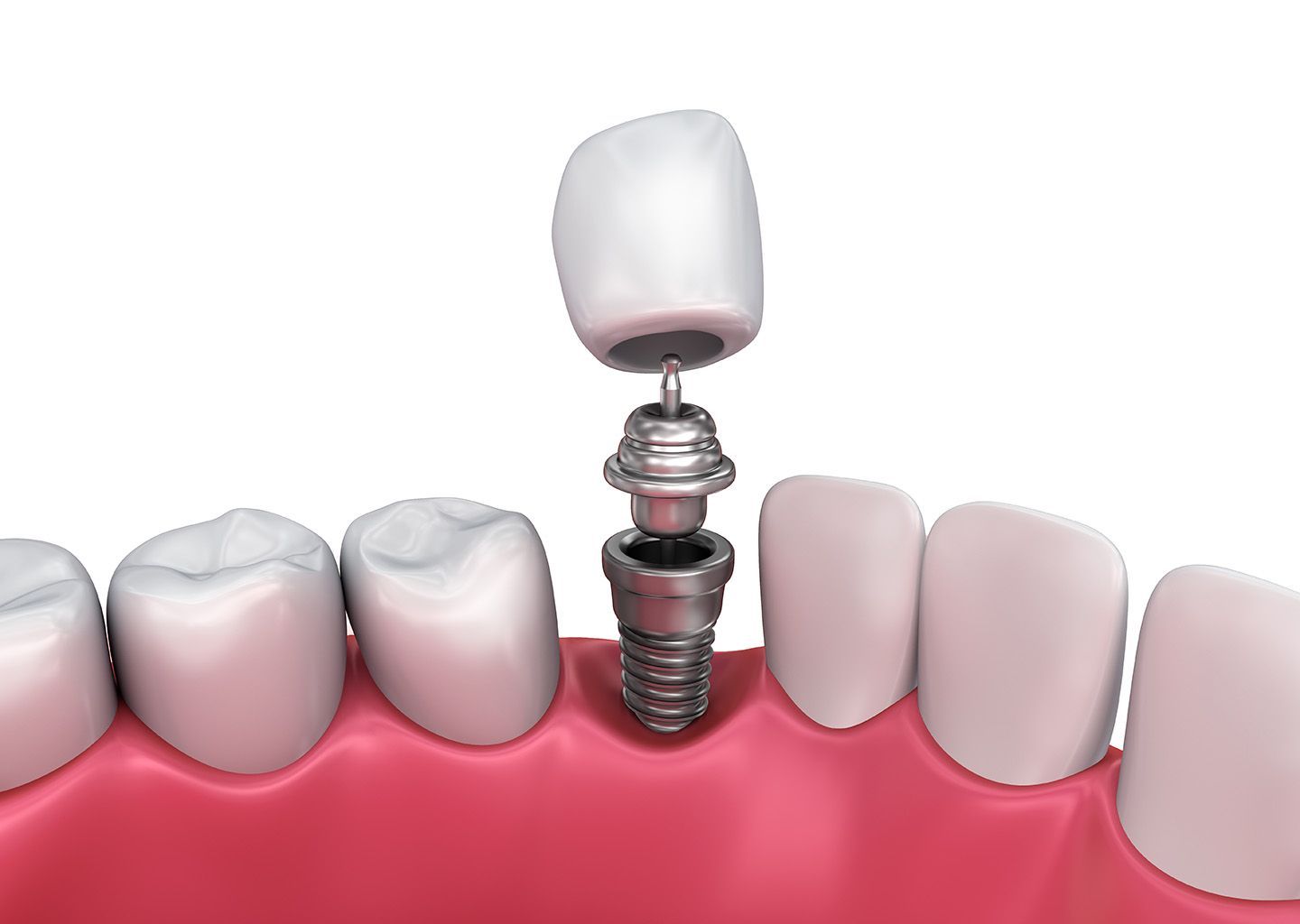 Dental implants procedure at Green Pond Dental in Jackson, NJ - restoring smiles and oral function.