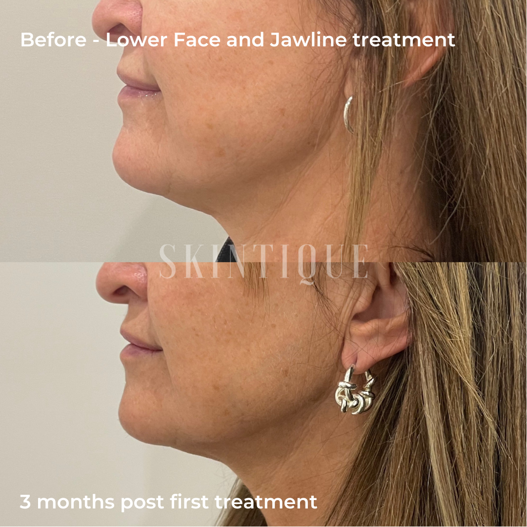 Before-and-after side-profile comparison of lower face and jawline treatment, showing a more defined jawline after 3 months