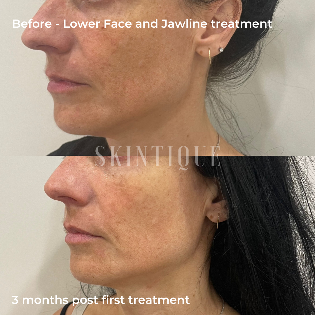 Before-and-after side profile of lower face and jawline treatment, showing reduced sagging after 3 months.
