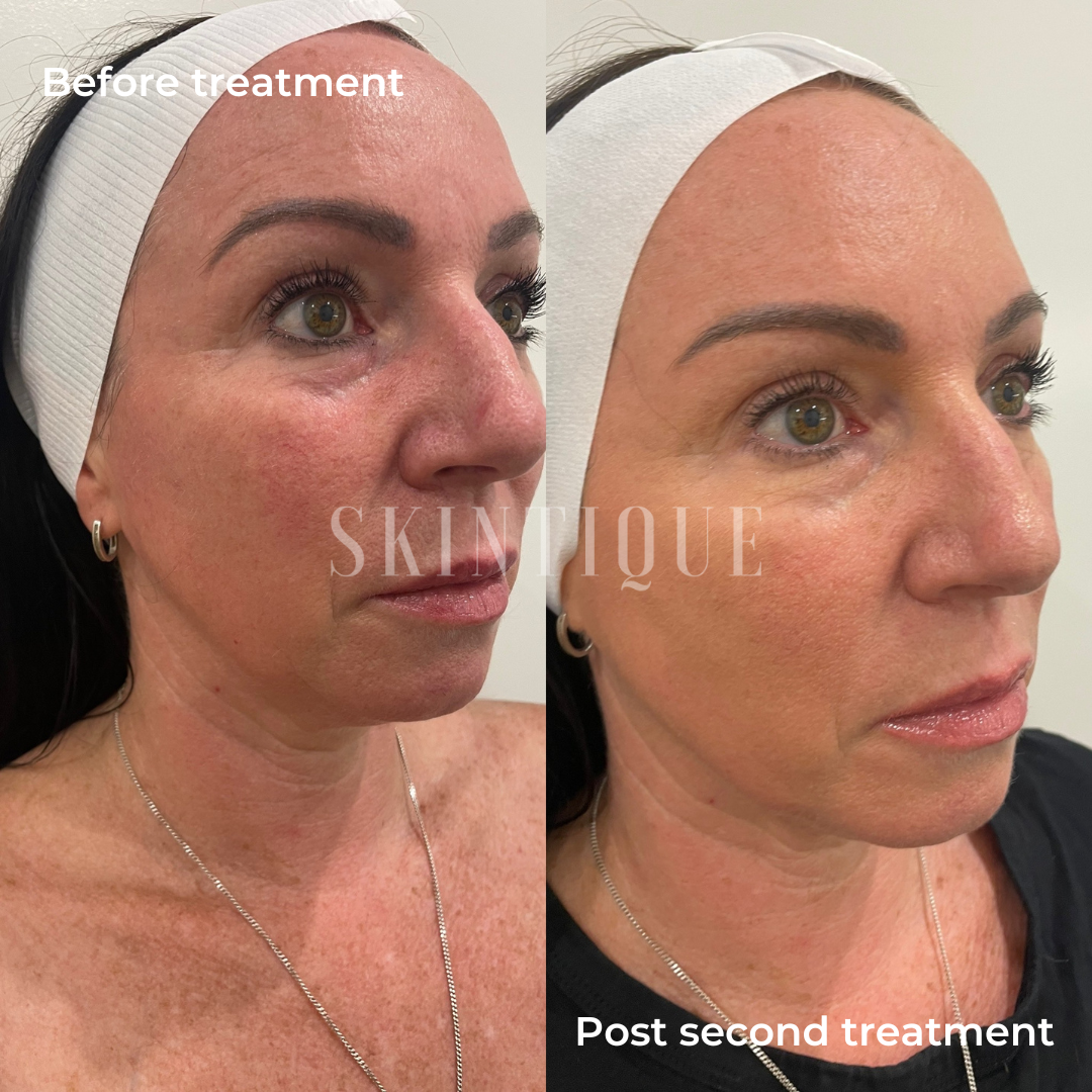 Before-and-after facial treatment comparison with a woman in a headband, side profile views.