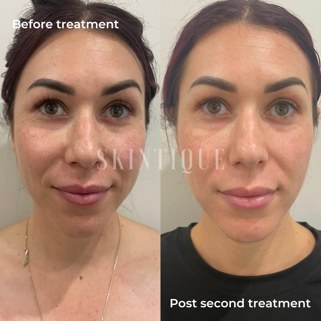 Side-by-side facial comparison labeled before treatment and after second treatment, showing reduced redness and smoother skin