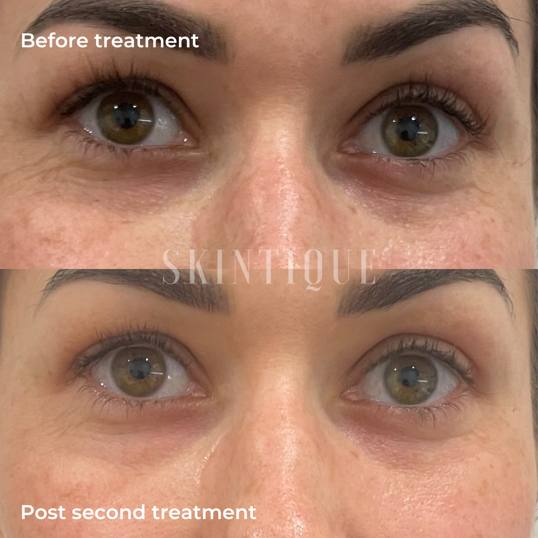 Side-by-side close-up of under eyes before and after a second treatment.