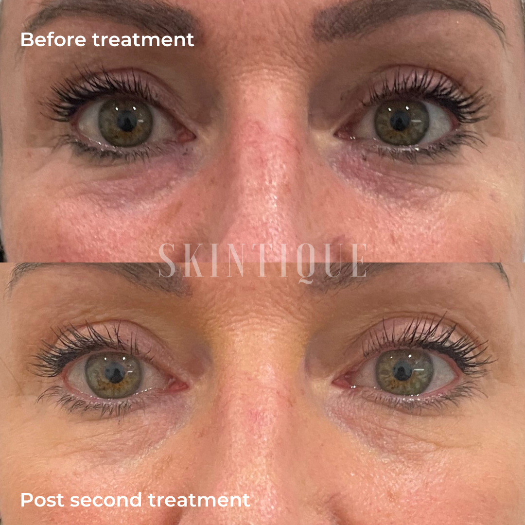 Before and after eye treatment close-up, showing reduced under-eye lines and dark circles.