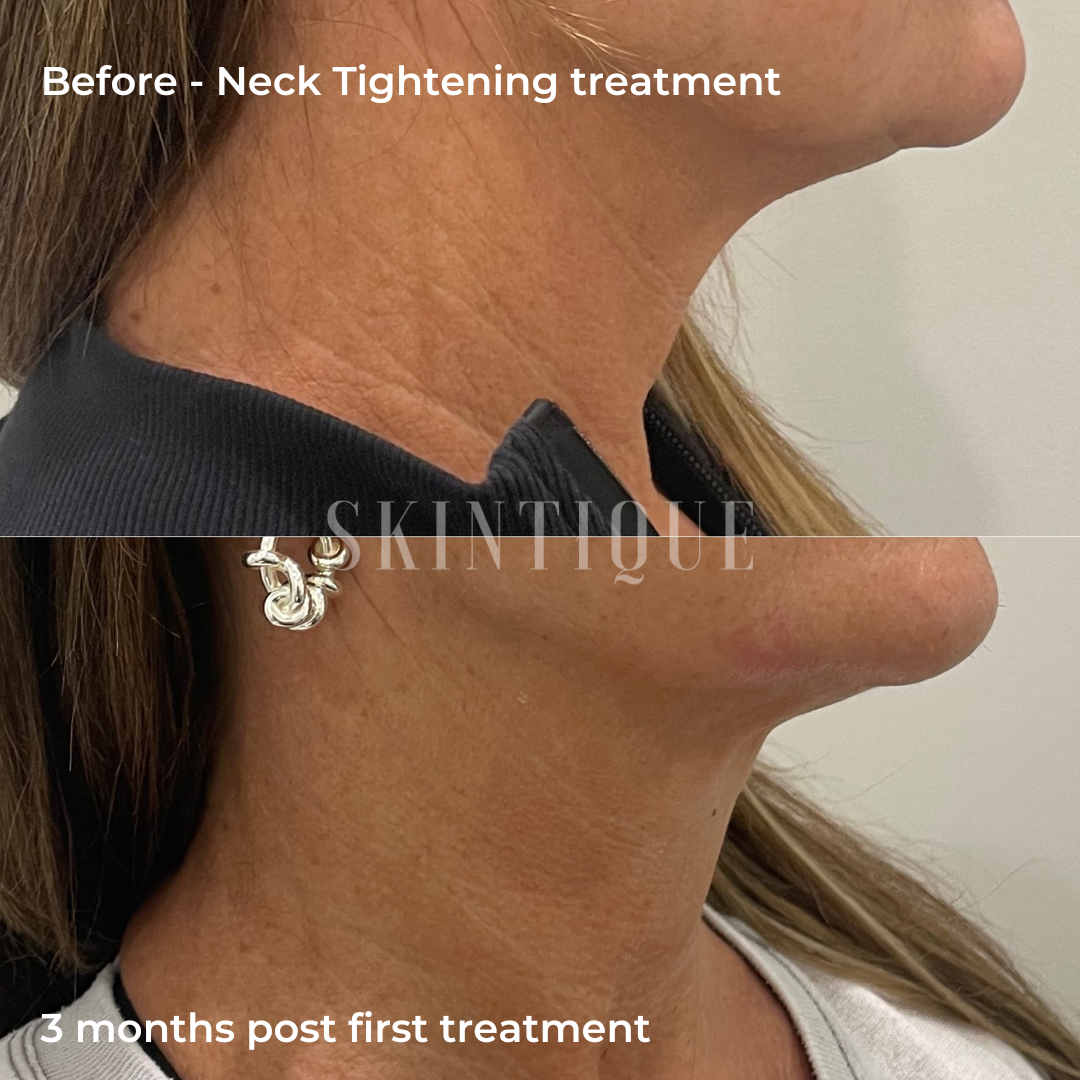 Before-and-after side profile of neck tightening treatment, showing smoother neck skin after 3 months