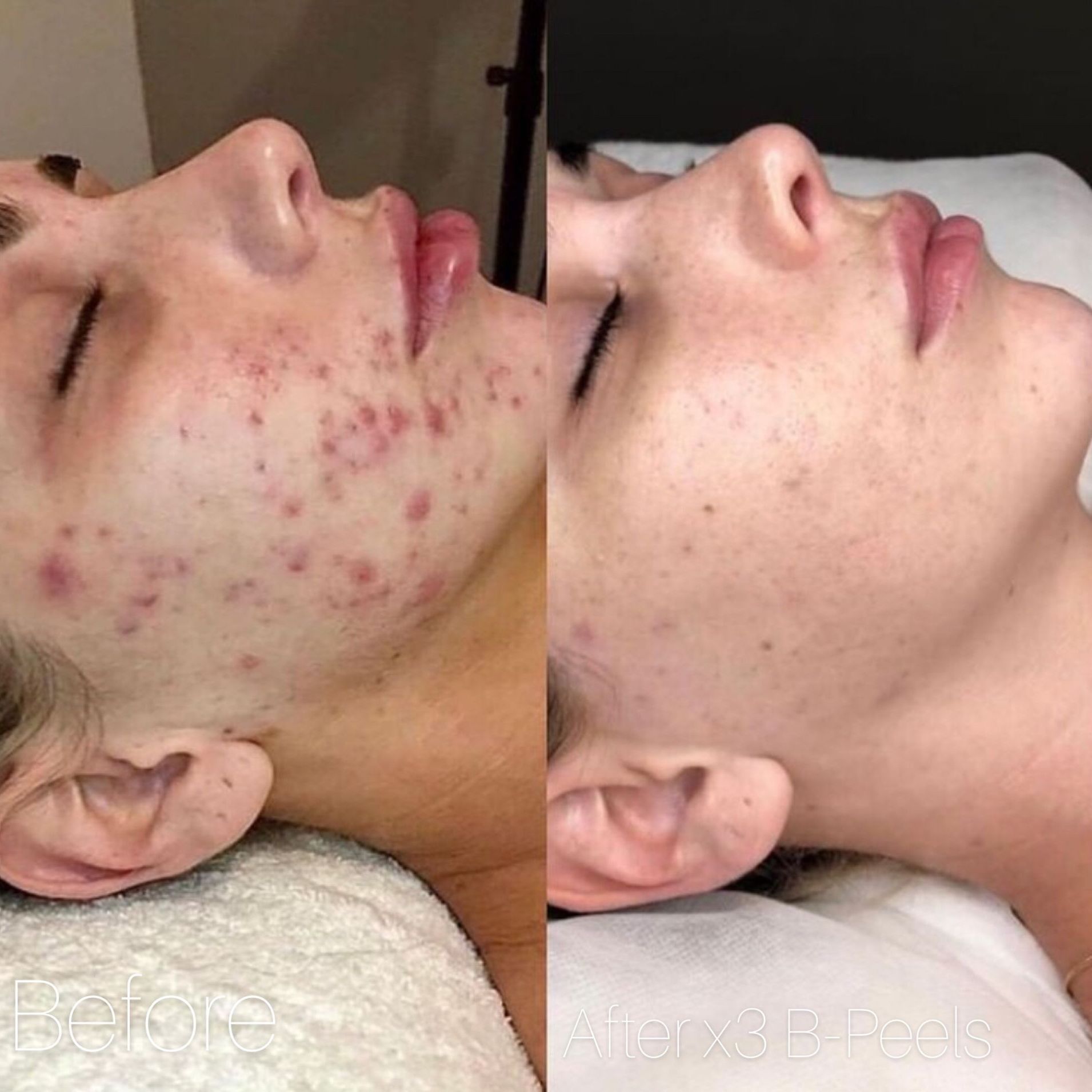 Side-by-side profile of a face with acne on the left and clearer skin on the right.