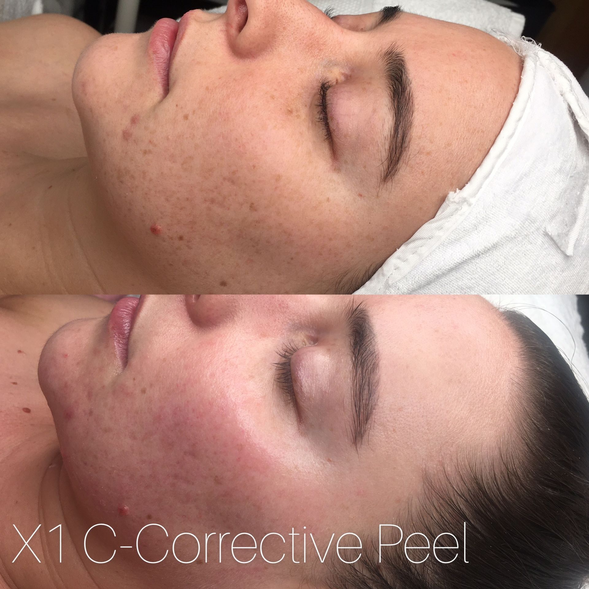 Two women lying face-up with white headbands during a corrective peel facial treatment