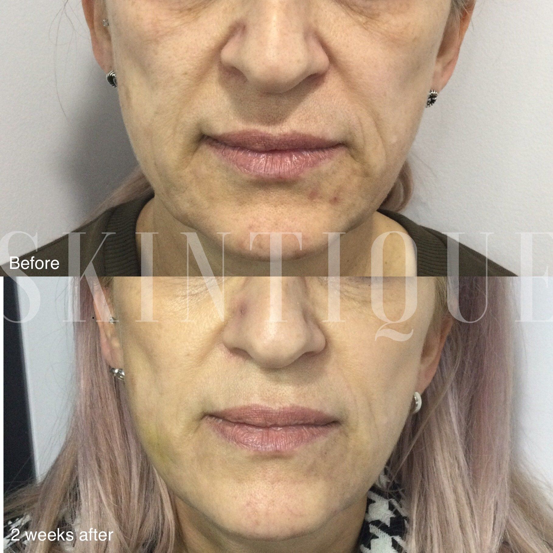 Before-and-after close-up of a person’s lower face and neck, showing smoother skin after treatment.