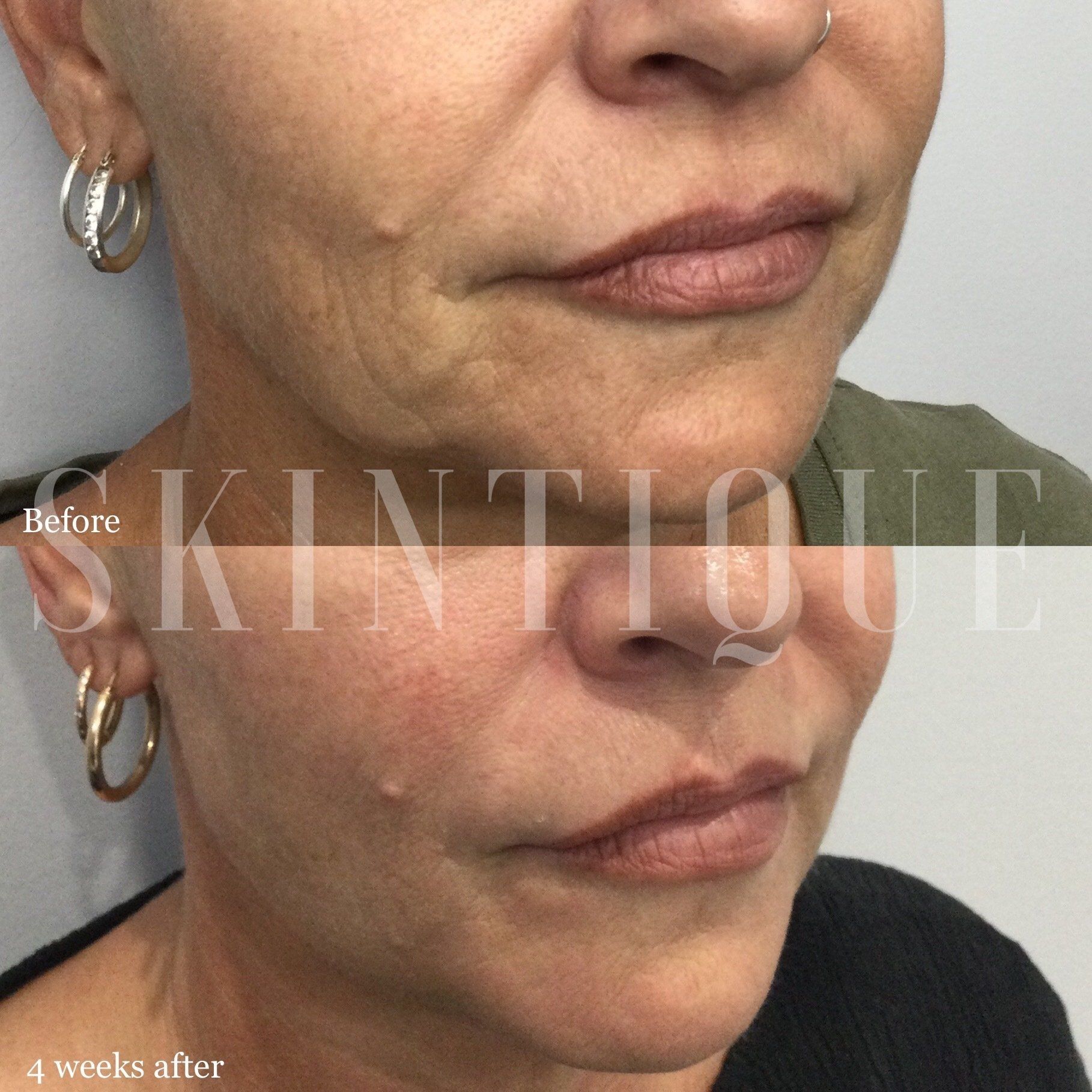 Before-and-after profile close-up of a person’s lower face and neck, showing skin tightening after 4 weeks.