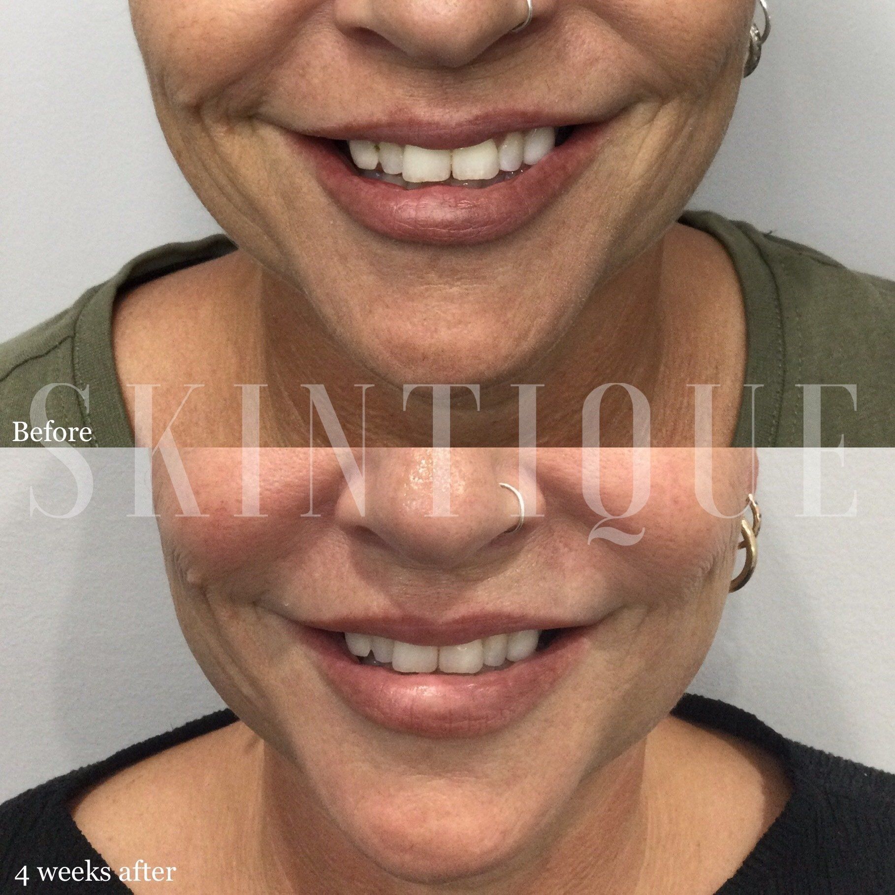 Before-and-after close-up of a smiling mouth and lower face with subtle skin smoothing treatment results